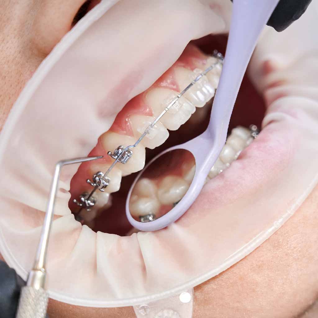 Orthodontic Treatments
